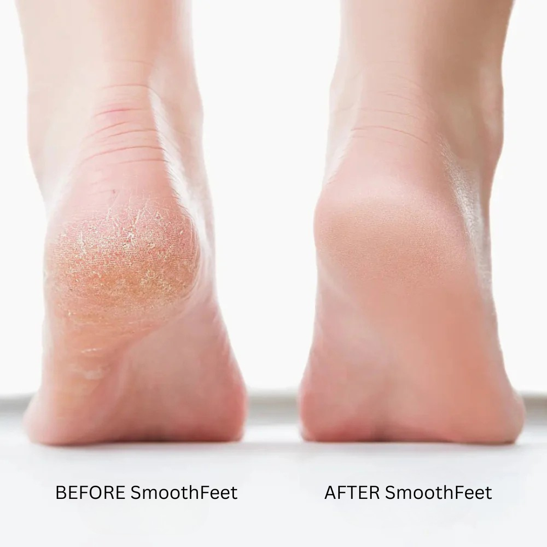 SmoothFeet Electric Foot File